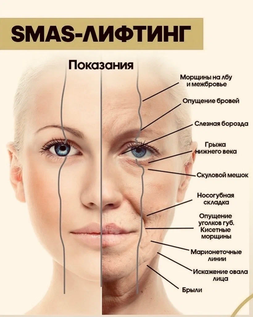 SMAS лифтинг лица